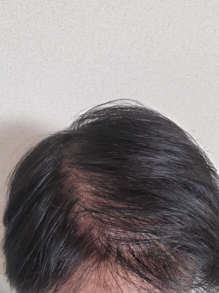 スーパーミリオンヘアー使用前