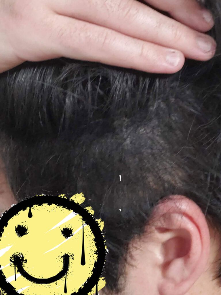 こめかみ周りスーパーミリオンヘアー使用後
