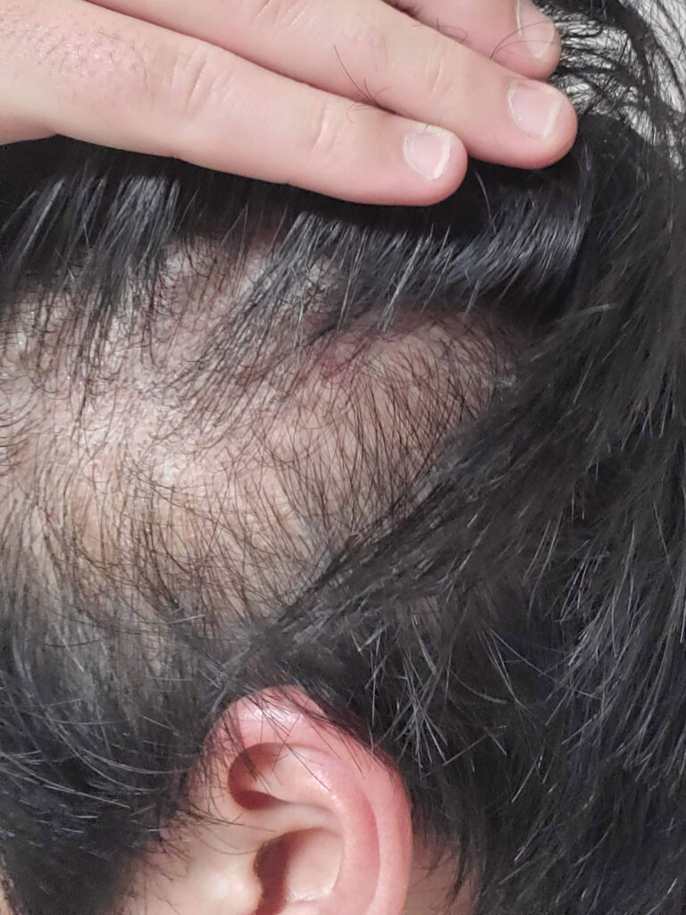 こめかみ周りスーパーミリオンヘアー使用前