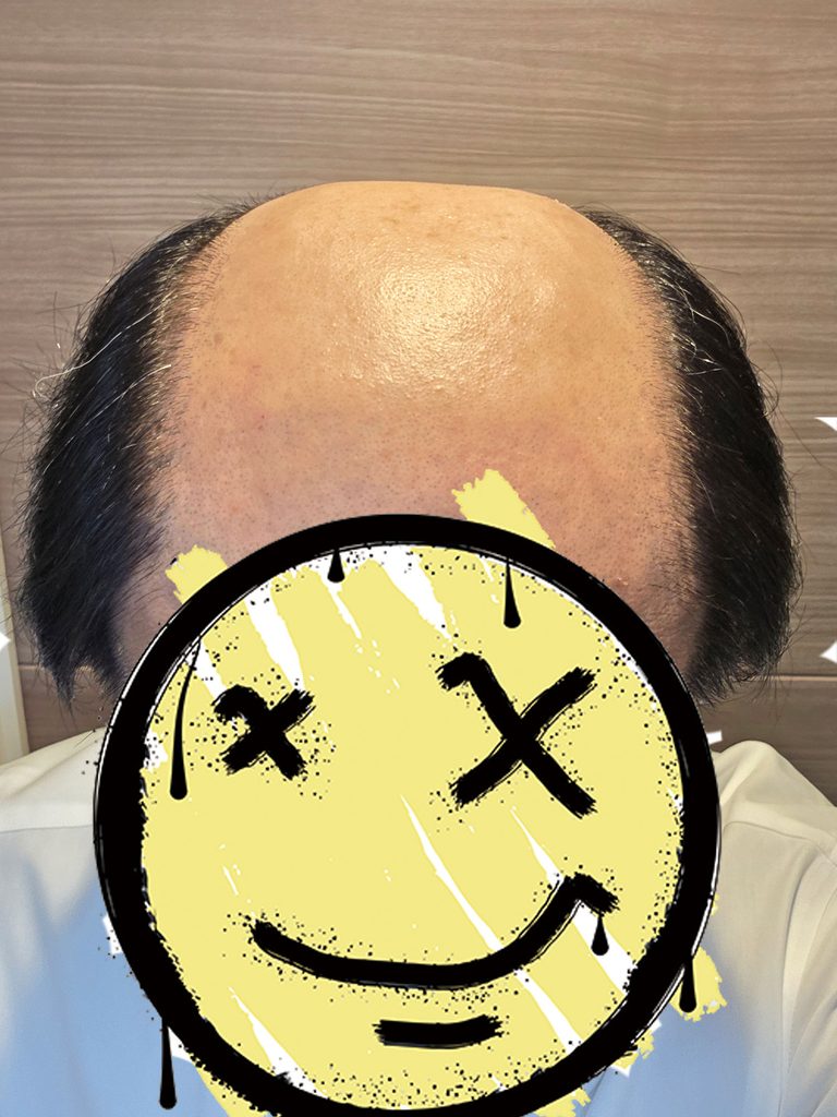 落ち武者スタイル